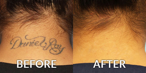 Tattoo Removal Dermatology