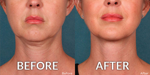 Mini Facelift Dermatology