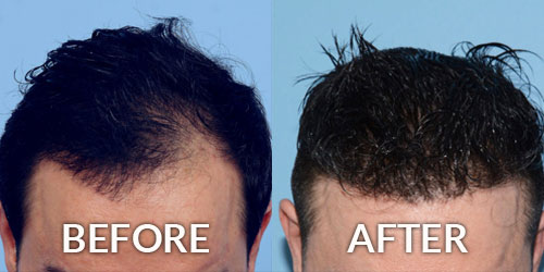 Hair Transplant Restoration