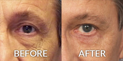 Blepharoplasty Eye Surgery