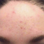 Acne Treatment Before & After Patient #4265