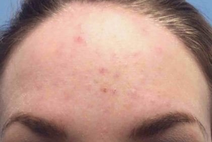 Acne Treatment Before & After Patient #4265