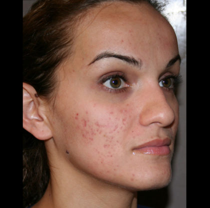 Acne & Complexion Issues Before & After Patient #4262
