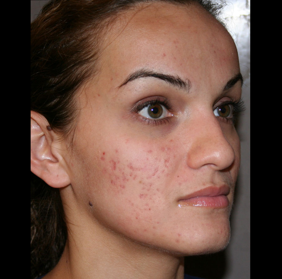 Accutane Before & After Patient #4262