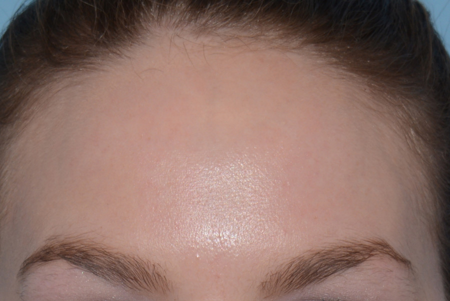Acne Treatment Before & After Patient #4265