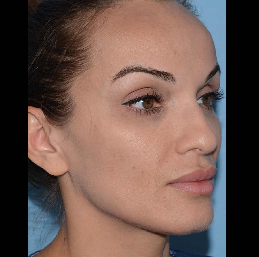 Accutane Before & After Patient #4262