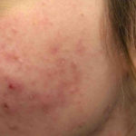 Acne Treatment Before & After Patient #4268