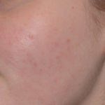 Acne Treatment Before & After Patient #4268