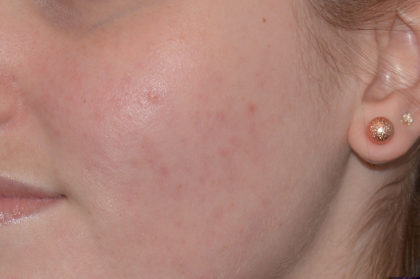 Acne Treatment Before & After Patient #4268