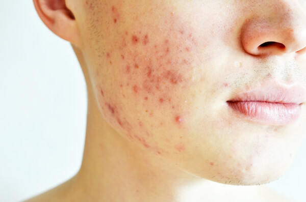 acne treatment procedure