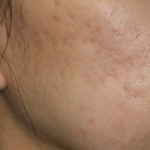 Active & Max FX Laser Before & After Patient #4568