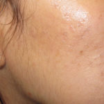 Active & Max FX Laser Before & After Patient #4568
