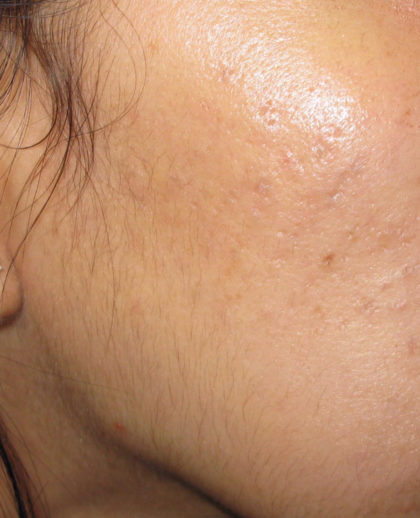 Active & Max FX Laser Before & After Patient #4568