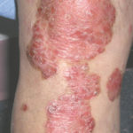 XTRAC Psoriasis Before & After Patient #4605