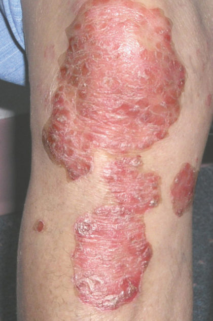 XTRAC Psoriasis Before & After Patient #4605