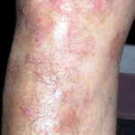 XTRAC Psoriasis Before & After Patient #4605