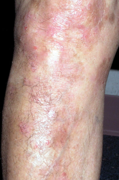 XTRAC Psoriasis Before & After Patient #4605