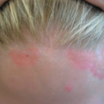 XTRAC Psoriasis Before & After Patient #4608