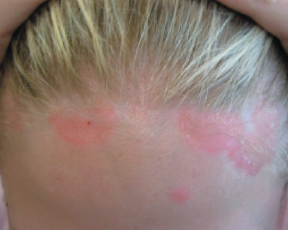 XTRAC Psoriasis Before & After Patient #4608