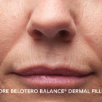 Belotero Before & After Patient #4283