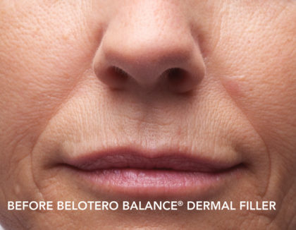 Belotero Before & After Patient #4283