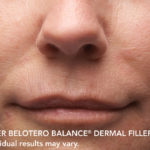 Belotero Before & After Patient #4283