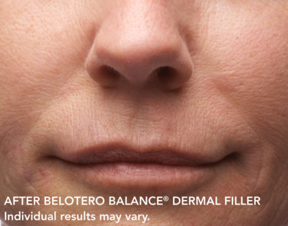 Belotero Before & After Patient #4283