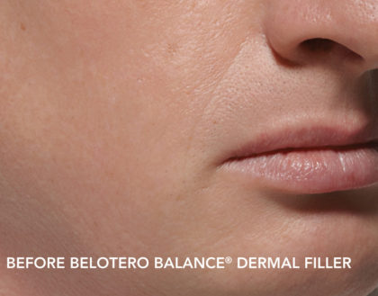 Belotero Before & After Patient #4286