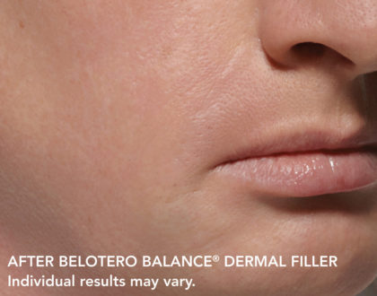 Belotero Before & After Patient #4286