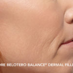 Belotero Before & After Patient #4289