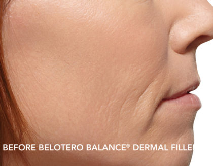 Belotero Before & After Patient #4289