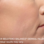 Belotero Before & After Patient #4289