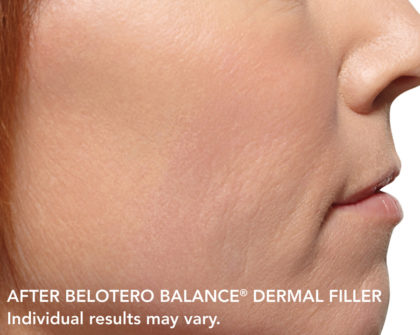 Belotero Before & After Patient #4289