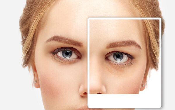 brow lift procedure