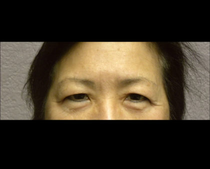 Brow Lift Before & After Patient #4322