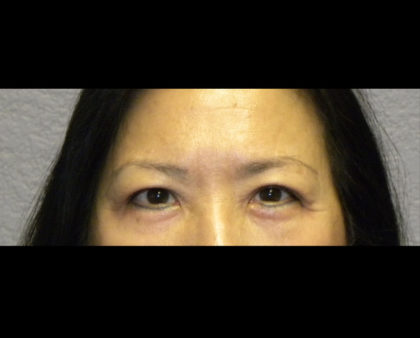 Brow Lift Before & After Patient #4322