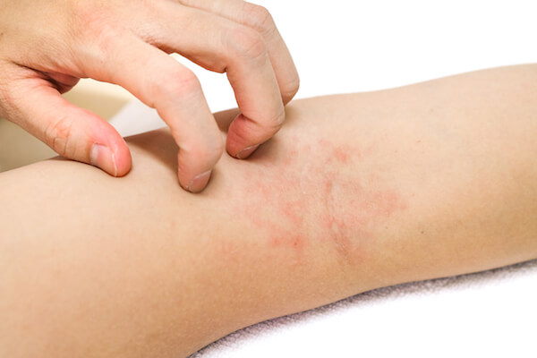 dermatitis eczema procedure