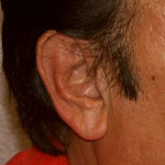 Earlobe Repair Before & After Patient #4328