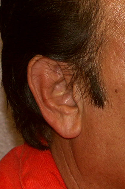 Earlobe Repair Before & After Patient #4328