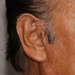 Earlobe Repair Before & After Patient #4328