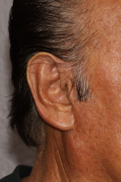 Earlobe Repair Before & After Patient #4328