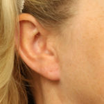 Earlobe Repair Before & After Patient #4333