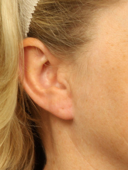 Earlobe Repair Before & After Patient #4333