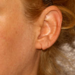 Earlobe Repair Before & After Patient #4337