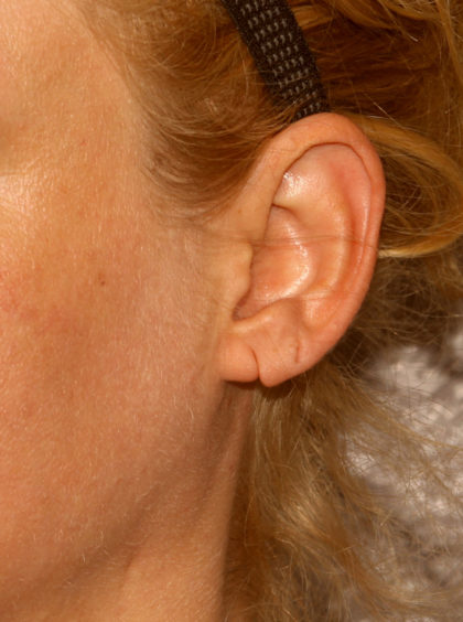 Earlobe Repair Before & After Patient #4337