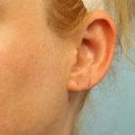 Earlobe Repair Before & After Patient #4337