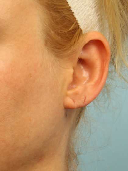 Earlobe Repair Before & After Patient #4337