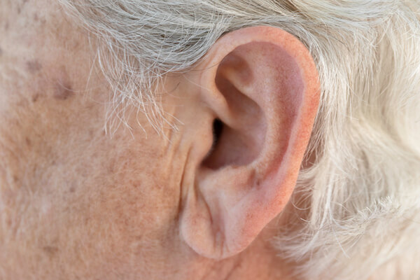 Earlobe Wrinkles