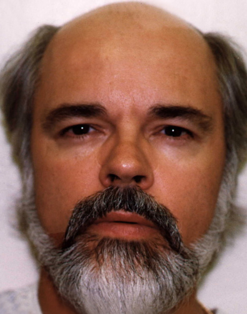 Hair Transplant Before & After Patient #4372