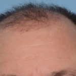 Hair Transplant Before & After Patient #4358